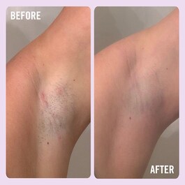 Ingrown Hair Pads with BHA&AHA - Ingrown Hair Skin treatment