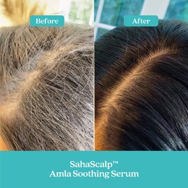 SahaScalp™ Scalp Reset Kit - Haircare kit