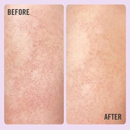 KP Bump Eraser Body Scrub - 10% AHA