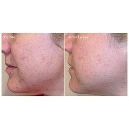 Daily Clarifying Peel
