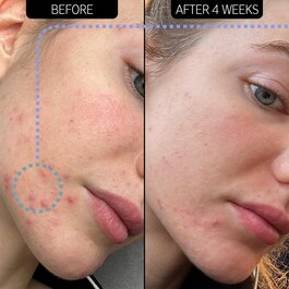 Blemish Clearing - Moisturizer 2% NovoRetin
