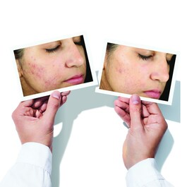 Blemish control - Invisiscar Resurfacing Treatment