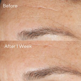 Replenishing - Multi-Acid Peel