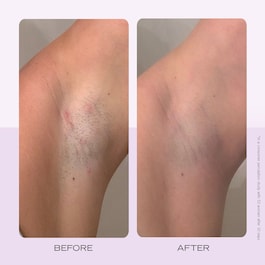 Ingrown Hair Pads - Rondeller til indgroede hår, 60 stk.