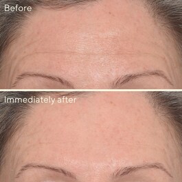 Resurgence - Targeted Wrinkle Corrector