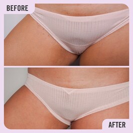 Ingrown Hair Pads with BHA&AHA - Ingrown Hair Skin treatment