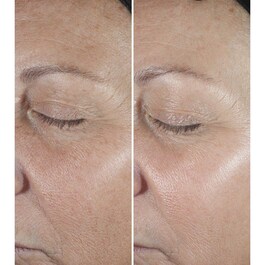 Smart Clinical Repair™ - Wrinkle Correcting Serum